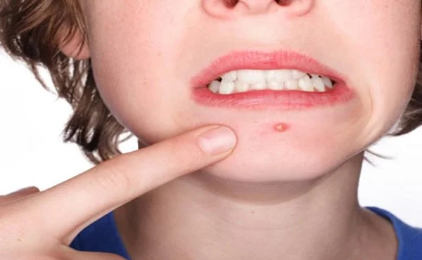 Como eliminar acne
