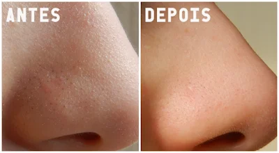 Remover CRAVOS NO NARIZ com Limão