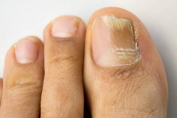 Listerine lucha hongos en las uñas