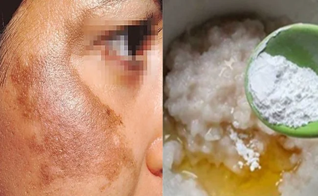 APLIQUE ISTO em SEU ROSTO e DIGA ADEUS ao MELASMA