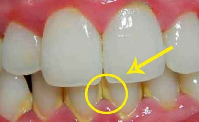 Cómo eliminar la placa y el sarro de forma natural