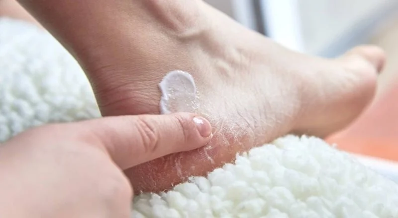 Como prevenir e tratar os pés rachados: Como prevenir e tratar os pés rachados:
