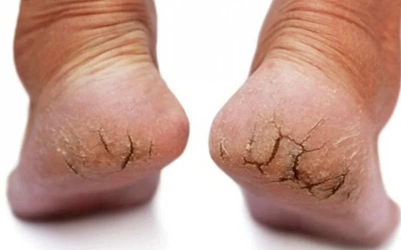 Como tirar rachaduras dos pés com bicarbonato e vinagre Porque os pés racham?
